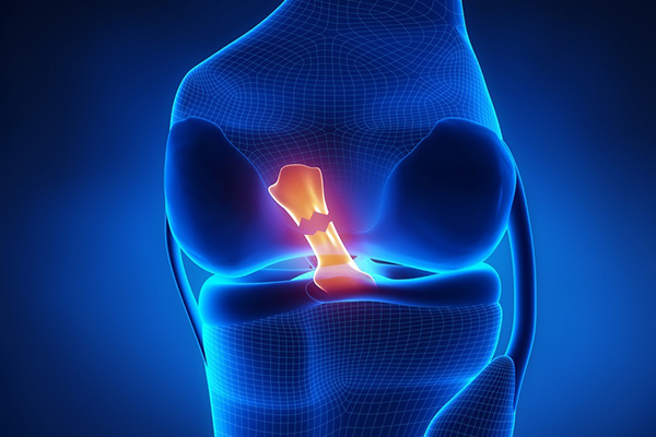 ACL Reconstruction in Boca Raton: Step-by-Step Surgical Process Explained